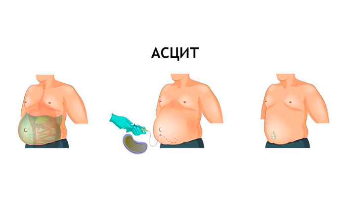 Операция лапароцентез для лечения асцита 3-й стадии
