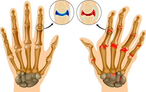 Деформации пальцев