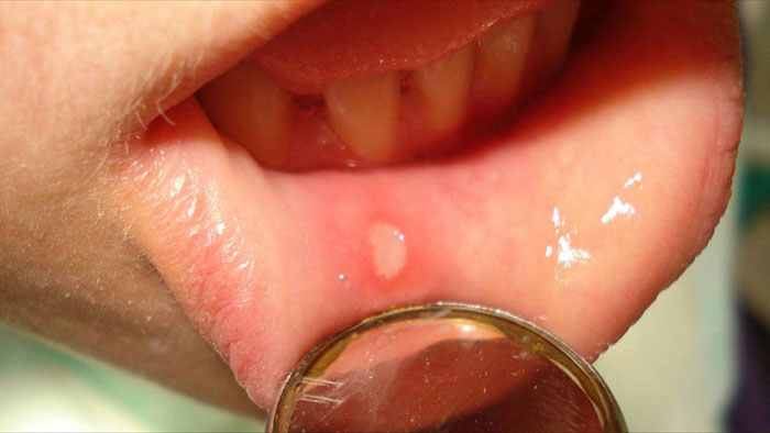 Важным аспектом является раннее диагностирование и распознавание ракового образования губы