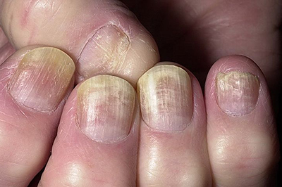 Болезнь ногтей