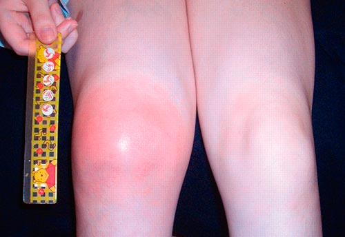Артрит коленного сустава у детей диагностика и методы лечения