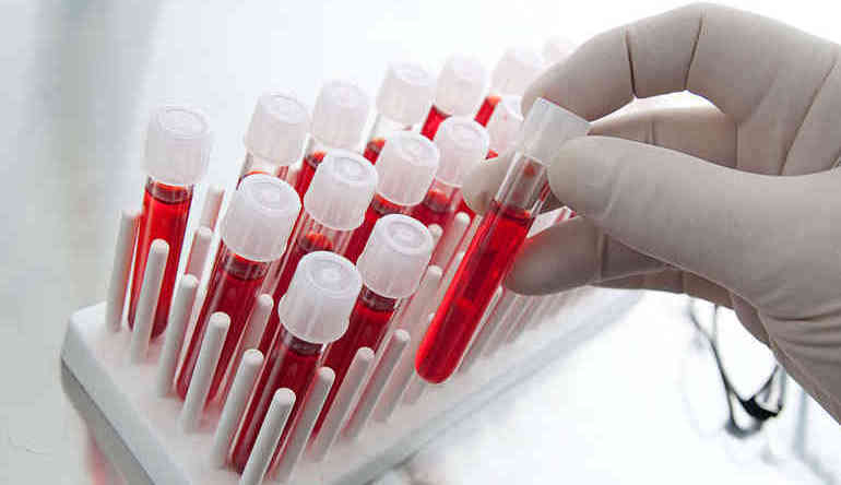 Как правильно сдать общий анализ крови при раке простаты?