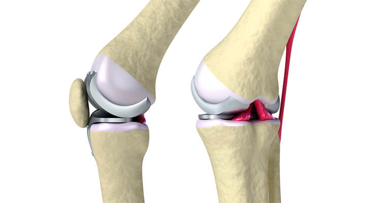 В чем суть операции на коленном суставе?