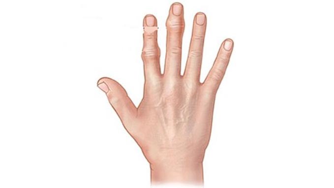 Шишки на пальцах рук причины появления, методы лечения