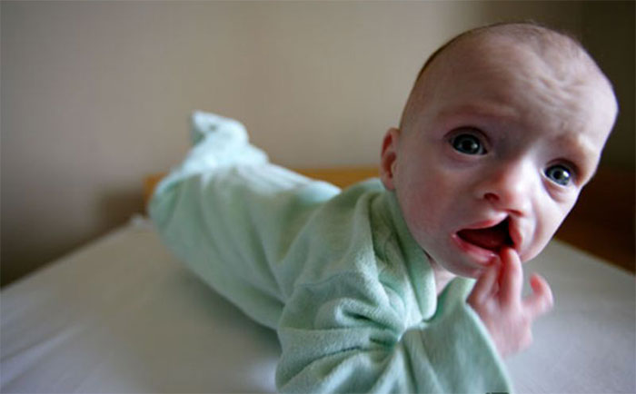 Употребление спиртного перед и во время зачатия может стать причиной различных патологий