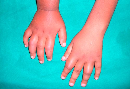 Реактивный артрит пальцев