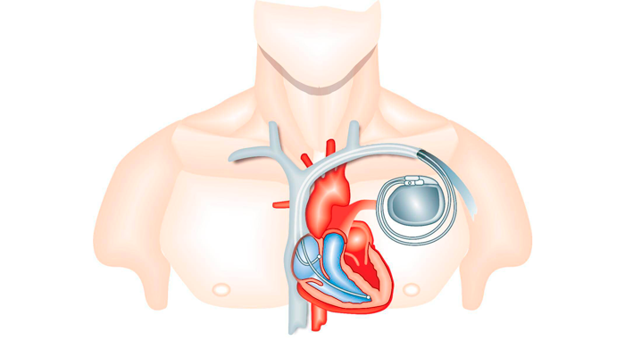 Запрет на проведения ТЭС-терапии при наличии кардиостимулятора в сердце человека
