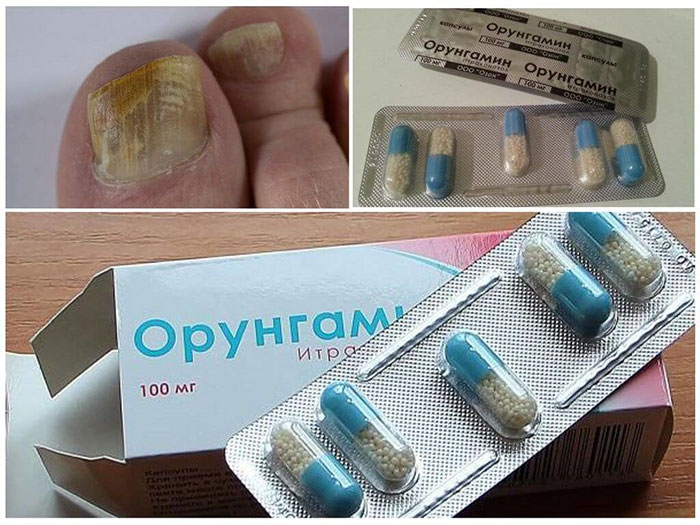 Орунгамин применяется для лечения различных грибковых инфекций