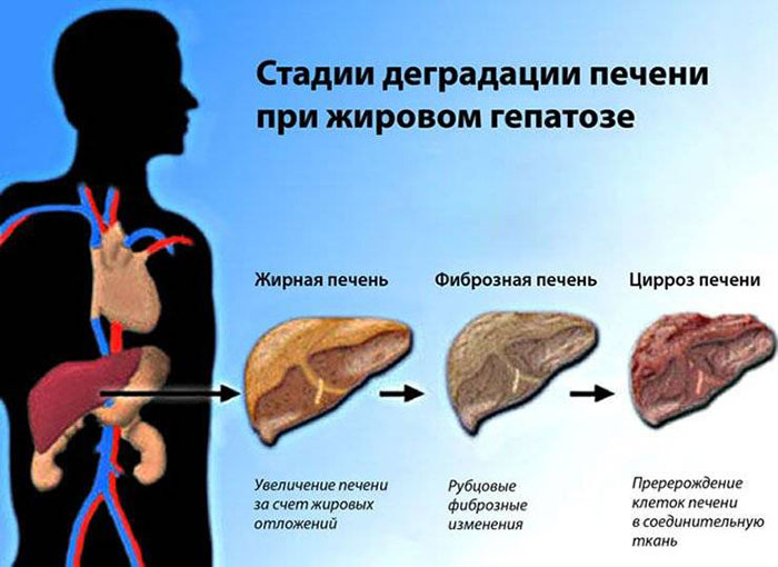 Этапы развития алкогольного жирового гепатоза