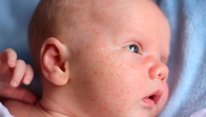 Аллергия у ребенка из-за содержания алкоголя в молоке матери при кормлении