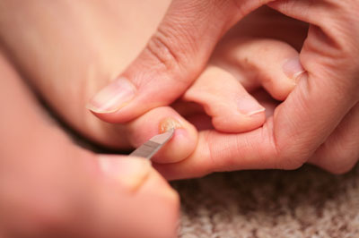 Удаление больного ногтя