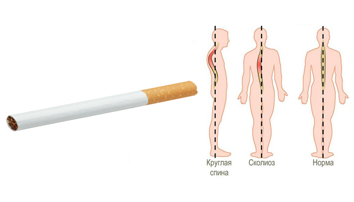 Появление сколиоза в следствии курения в подростковом возрасте