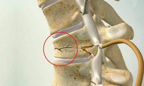 Как восстановить работу мышц спины thumbnail