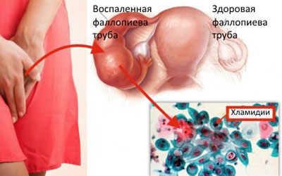 Хламидиоз и молочница лечение thumbnail