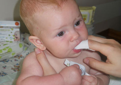 Обработка рта ребенка лекарством