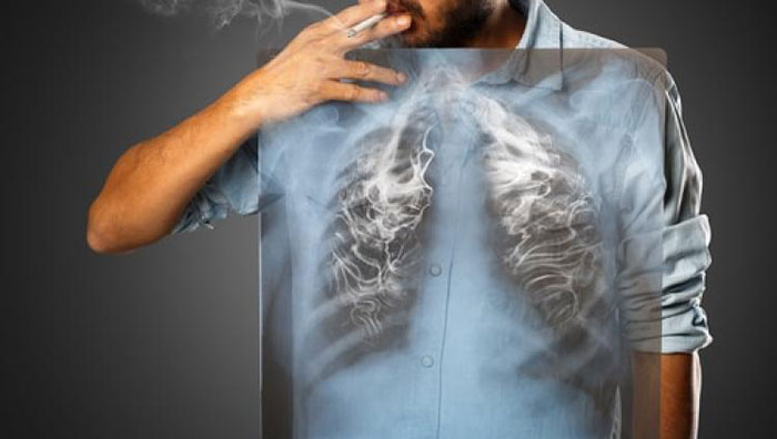 Как лечить кашель курильщика в домашних условиях: лучшие народные средства и медикаменты