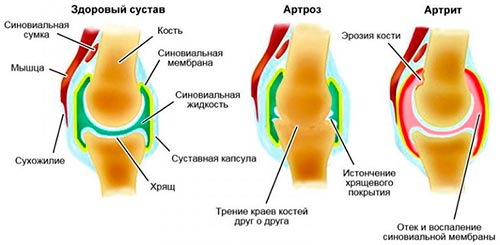 Артрит и артроз сустава