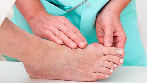 Методы лечения артроза большого пальца и других пальцев ног