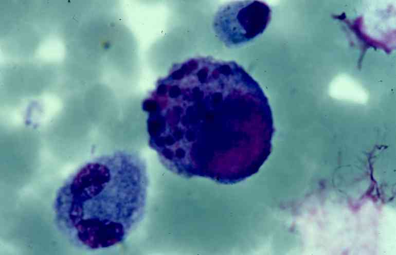 Цитомегаловирус чем он опасен и как с ним бороться?