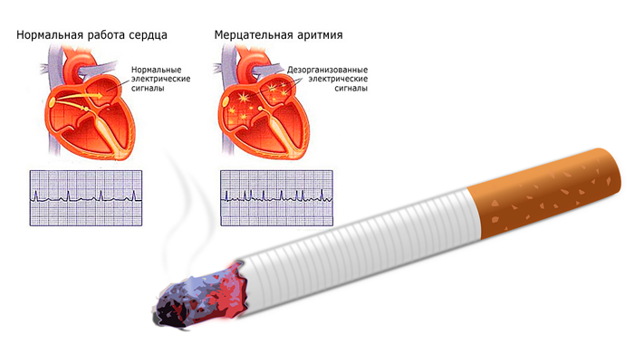 Аритмия в следствии регулярного курения