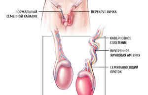 Перекрут яичка как проходит операция?