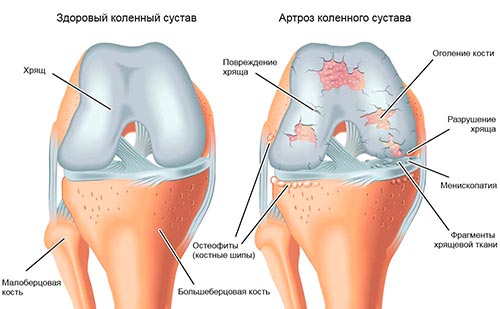 Причины, симптомы, степени и лечение артроза коленного сустава