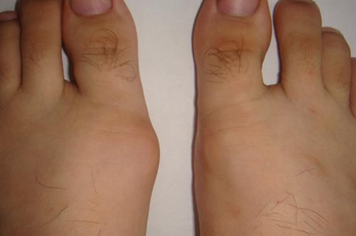 Что такое бурсит большого пальца стопы и как его лечить?