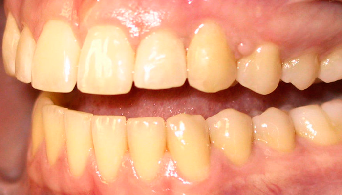 Пожелтение зубов в следствии злоупотребления медицинским никотином