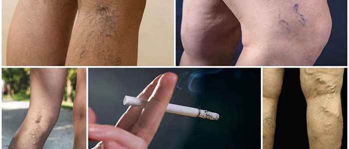 Курения усугубляет состояние больного и процесс лечения варикоза