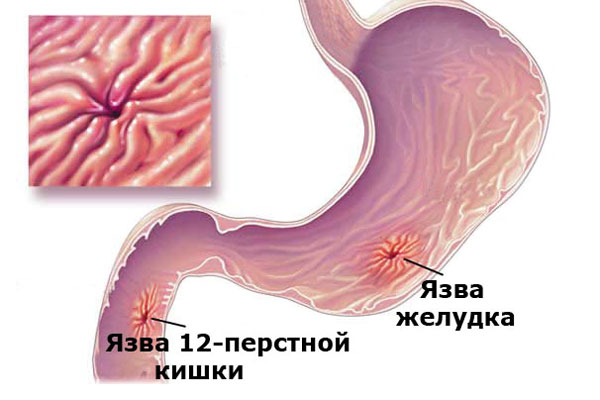 Язва желудка и двенадцатиперстной кишки, в результате длительного употребления Фентанила 