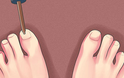 Нанесение йода на ногти ног