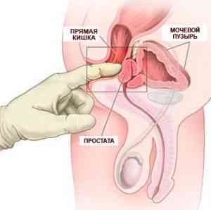Хронический небактериальный простатит. Распознай и победи!