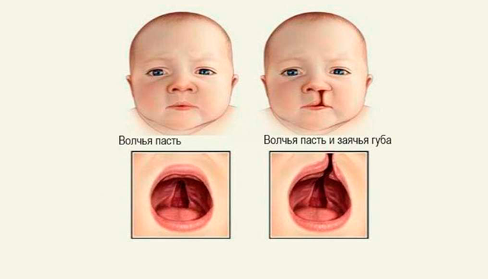 Возможная волчья пасть или заячья губа у ребенка в следствии курения при беременности